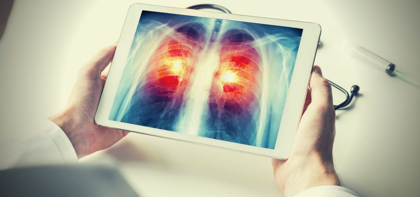 Optellum enters a strategic partnership with the Lung Cancer Initiative at Johnson & Johnson