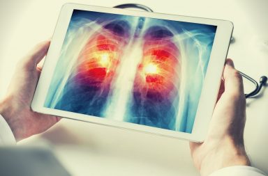 Optellum enters a strategic partnership with the Lung Cancer Initiative at Johnson & Johnson