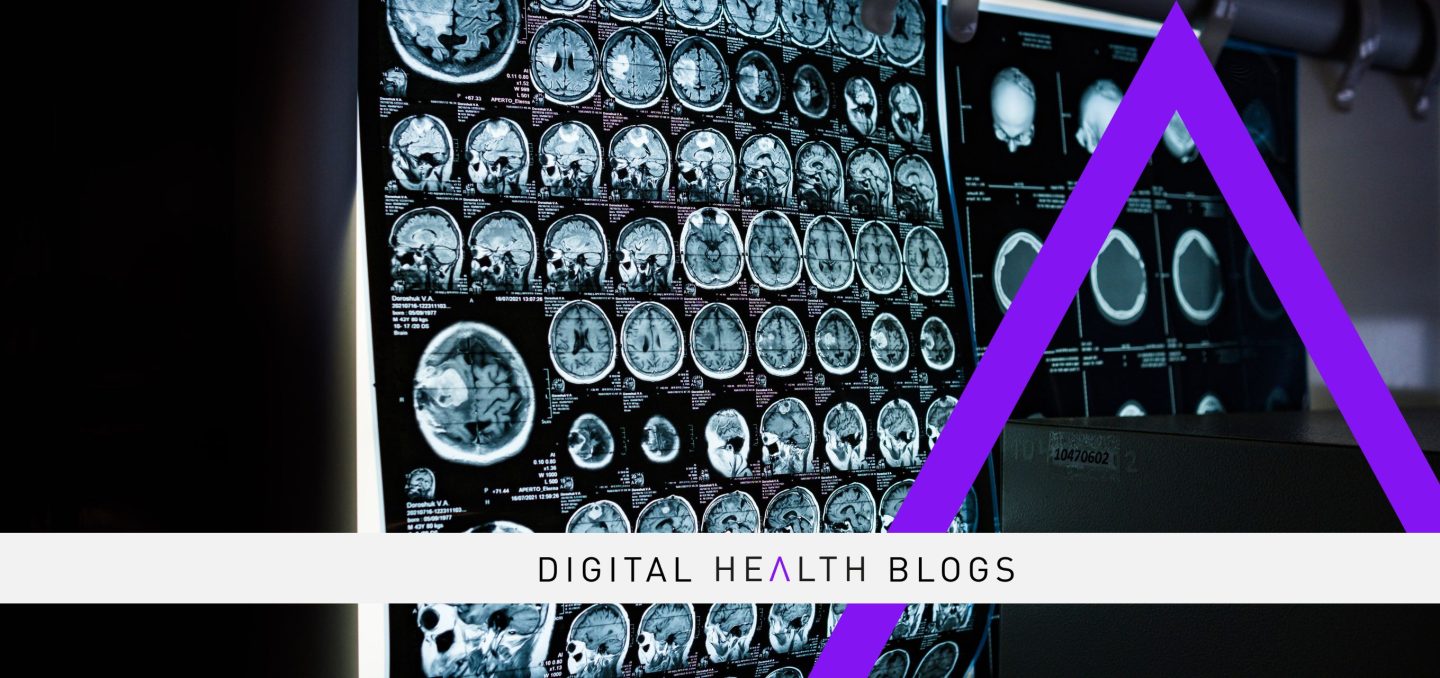 AI Uses Routine MRI Scans to Detect Sarcopenia in Children with Brain Tumours
